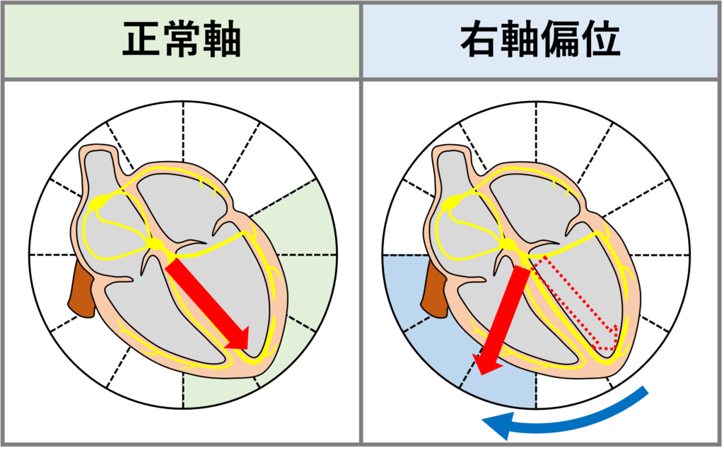 右軸偏位(right axis deviation)
通常の心室の電気的興奮は、房室結節から左下の心尖部方向へ向かいます。これが時計方向へ偏位した場合を右軸偏位といいます。