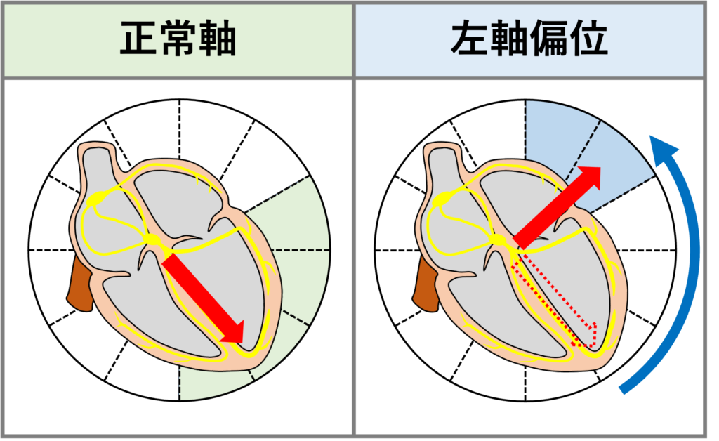 左軸偏位(left axis deviation)
通常は心室の電気的興奮は、房室結節から左下の心尖部方向へ向かいます。これが反時計方向へ偏位した場合を左軸偏位といいます。