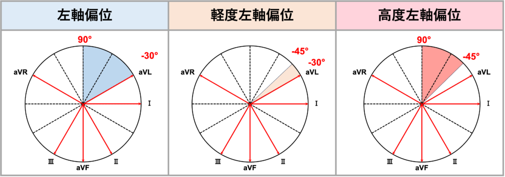 左軸偏位(left axis deviation)
定義上は電気軸が-30°〜-90°の時が左軸偏位になります。また、QRS波の電気軸-30°〜-45°の時を軽度左軸偏位、-45°〜-90°の時を高度左軸偏位と分類する場合もあります。