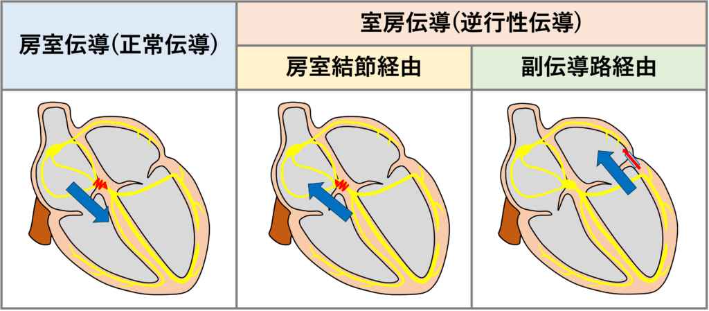 室房伝導(ventriculoatrial conduction)
室房伝導とは、心室から心房へ逆方向に電気刺激が伝わる現象のことです。通常の心臓の電気の流れは心房から心室へ向かう房室伝導ですが、これとは逆の心室から心房への逆行性伝導を室房伝導と呼びます。室房伝導の経路は大きく房室結節経由と副伝導路経由に分けられます。