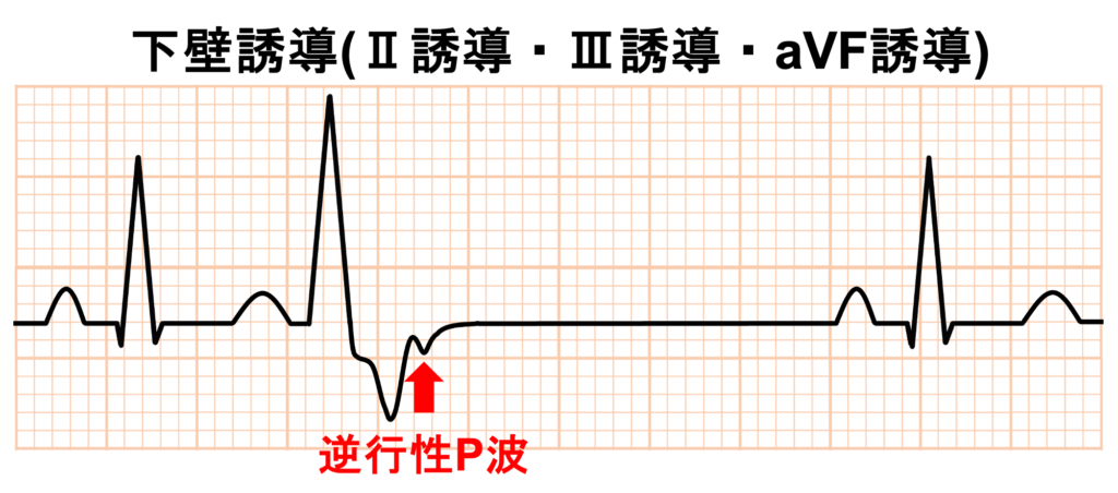 室房伝導(ventriculoatrial conduction)
房室結節経由の室房伝導は心電図では逆行性P波として出現します。QRS波の直後のST部分やT波の内部に下壁誘導(II誘導・III誘導・aVF誘導)で陰性P波が現れます。通常の洞性P波は下壁誘導で陽性なのでP波は逆向きになっています。