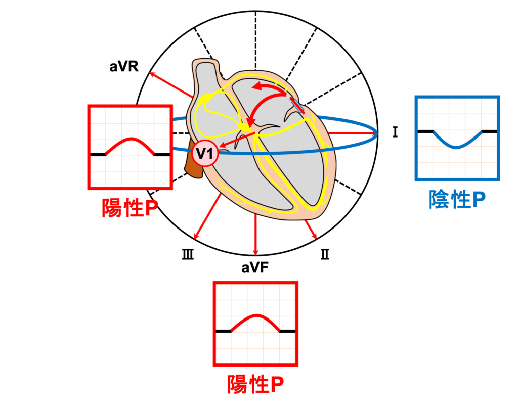 室房伝導(ventriculoatrial conduction)
副伝導路経由の室房伝導は心電図ではQRS波の直後のST部分やT波の内部に下壁誘導(II誘導・III誘導・aVF誘導)で陽性P波が現れます。通常の洞性P波は下壁誘導で陽性なのでP波は同じ向きになっています。左側副伝導路の室房伝導ではⅠ誘導が陰性P波、aVR誘導、V1誘導が陽性P波になる傾向があります。