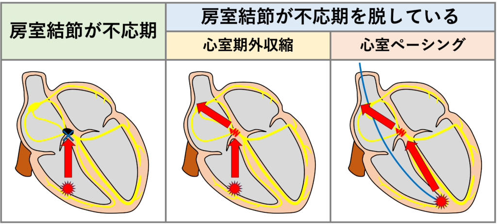 室房伝導(ventriculoatrial conduction)
心室の興奮が房室結節を逆方向に伝導して心房に到達します。正常な心臓では、房室結節の不応期が長いため心室から心房への逆伝導はほとんど起こりませんが、不応期を脱したタイミングで発生した心室期外収縮や心室ペーシングにおいて室房伝導が見られます。房室結節を通過するので伝導時間が比較的長く(通常100-200ms以上)なります。