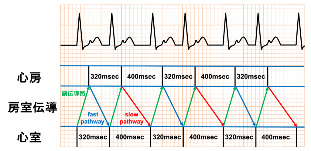 RR alternans
RR alternansはRR間隔が規則的に交互に変動します(例：短→長→短→長…)。一般的にRRの変動幅は数十msec程度(例：320msec ↔ 400msecなど)で、完全な周期性が典型的で1拍おきにRR間隔が変化します。