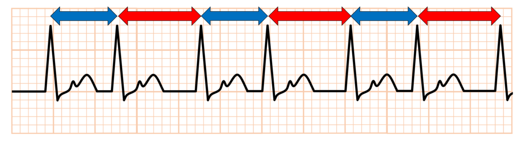RR alternans
RR alternansとは、隣接する2つのR波の間隔であるRR間隔、つまり1拍ごとの心周期が交互に長短を繰り返す現象を指します。これはelectrical alternans(電気的交互脈)の1つの形態で、RR間隔の1拍毎の変化として現れます。多くの場合、QRS振幅やT波の波形変化と同時に見られるので総称してelectrical alternansの一部として扱われます。