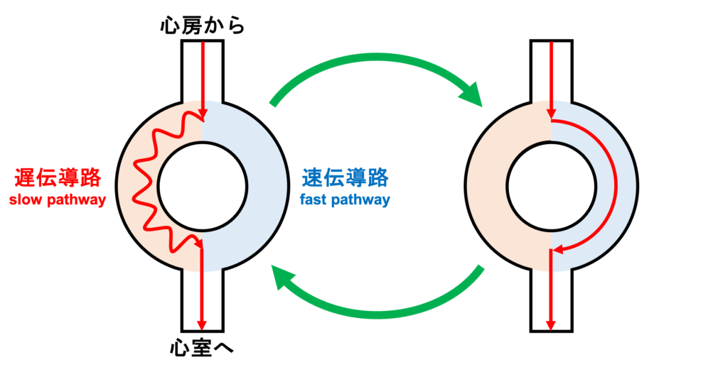 RR alternans
AVNRT、AVRT、ATなどで、fast/slow pathwayの交互伝導が最も一般的な原因です。偽性電気的交互脈(pseudo-electrical alternans)としても知られています。