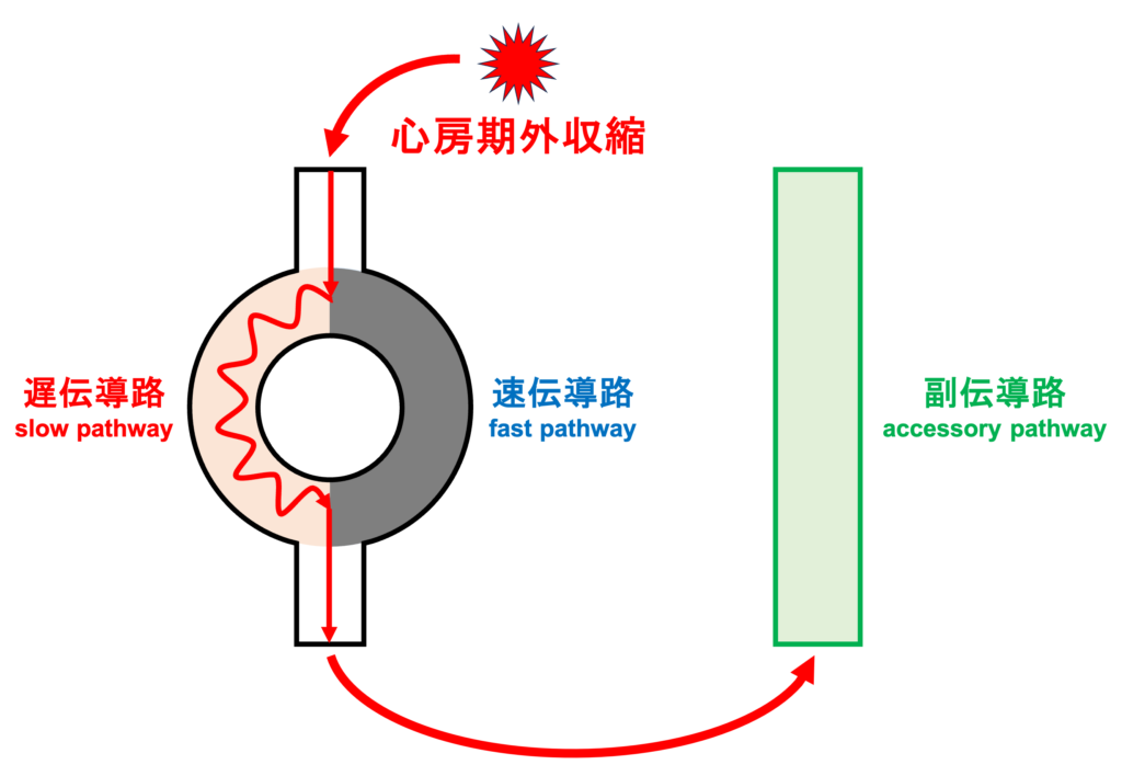 RR alternans
fast pathwayとslow pathwayではfast pathwayの方が不応期が長いです。fast pathwayが不応期のタイミングで心房期外収縮が生じることで興奮がslow pathwayを通って心室に伝わります。