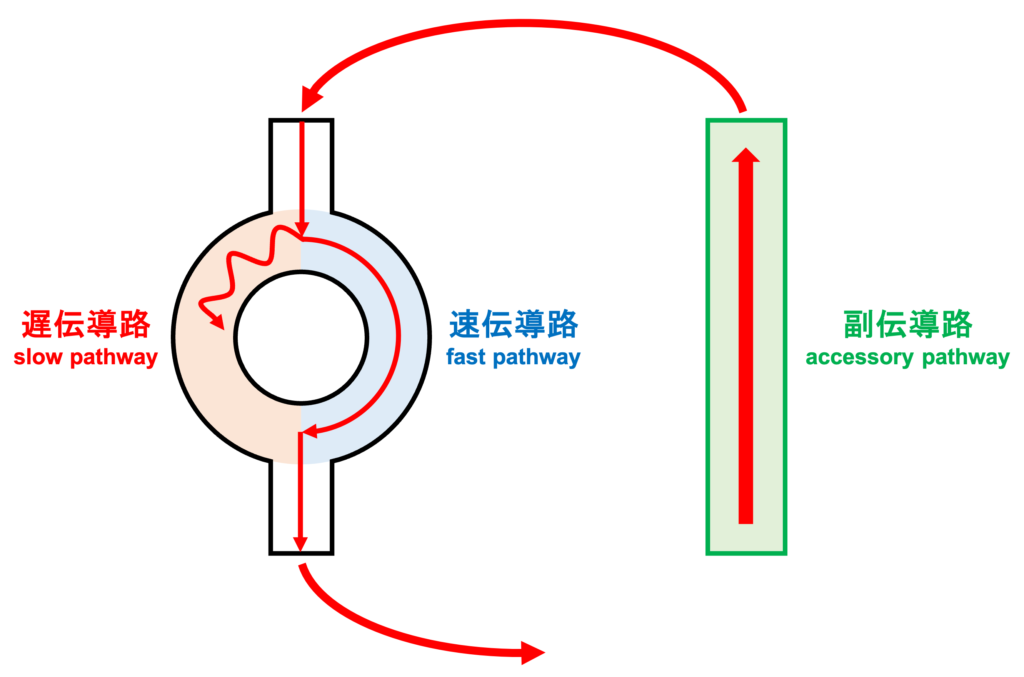 RR alternans
そして心室の興奮が副伝導路を経由して心房に伝わります。この時、slow pathwayを通過する時に時間がかかっているのでfast pathwayは不応期から回復しています。またslow pathwayも不応期が短いため回復はしていますが、伝導速度はfast pathwayが速いためfast pathwayを通過して興奮が心室に伝導します。