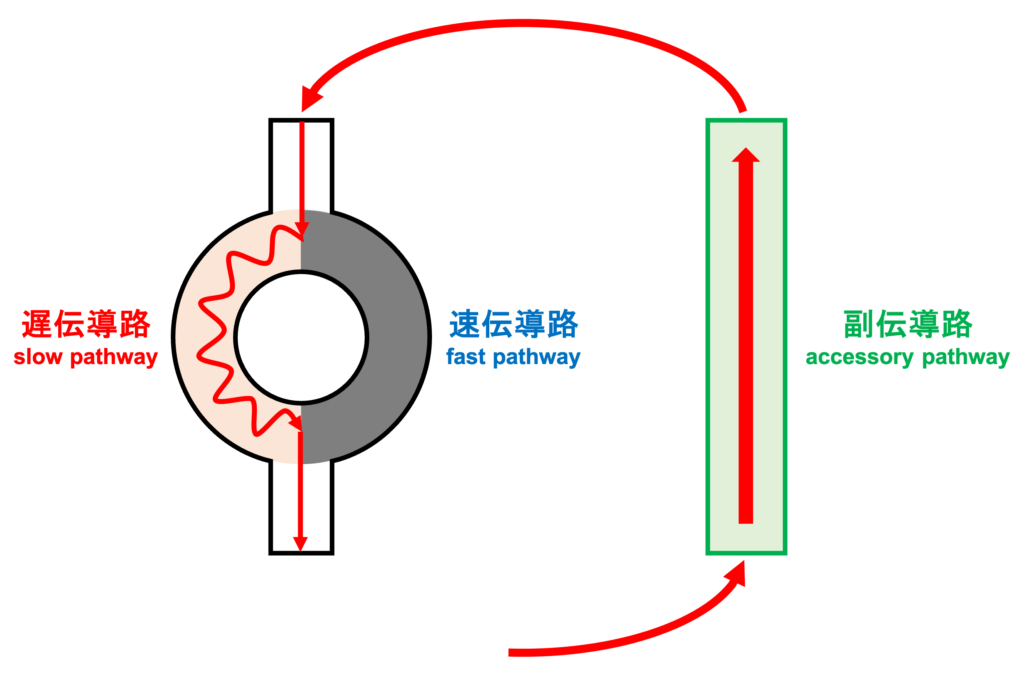 RR alternans
心室の興奮が副伝導路を経由して心房に伝わりますが、この時、fast pathwayを通過する時にかかる時間は短いのでfast pathwayはまだ不応期から回復していません。slow pathwayは不応期が短いため回復しているのでslow pathwayを通過して興奮が心室に伝導します。このサイクルを繰り返すことでAVRTのRR alternansが持続します。