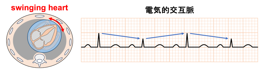 electrical alternans(電気的交互脈)