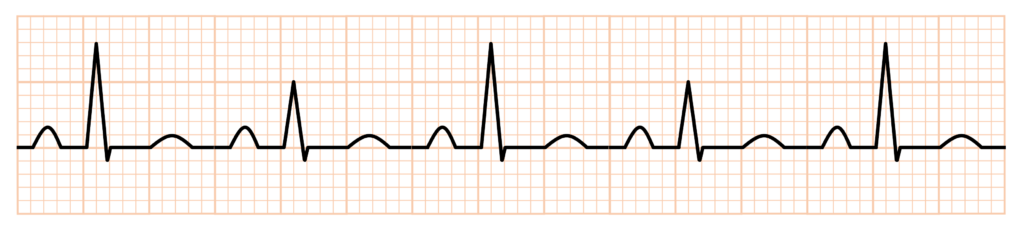 electrical alternans(電気的交互脈)
