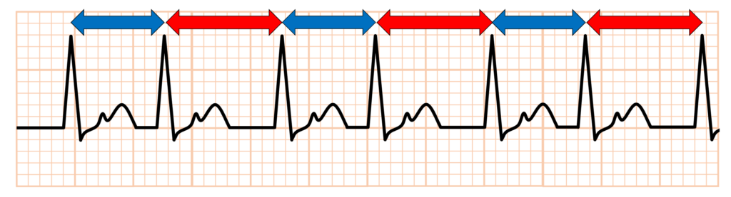 electrical alternans(電気的交互脈)
1拍ごとの心周期が交互に長短を繰り返している場合はRR alternansと呼ばれ、fast/slow pathwayが存在する場合にこれらの伝導路を交互に伝導することが最も一般的な原因です。