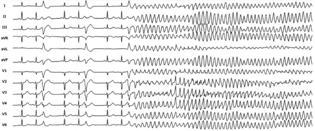 Short-coupled variant of torsade de pointes