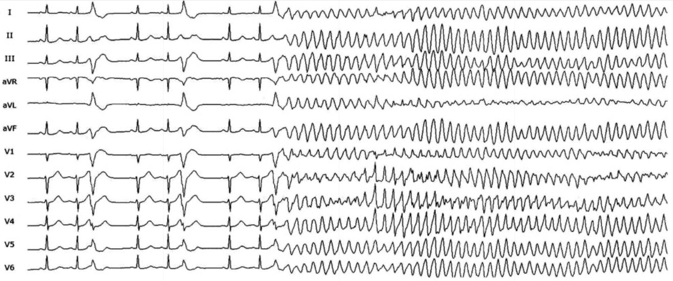 Short-coupled variant of torsade de pointes