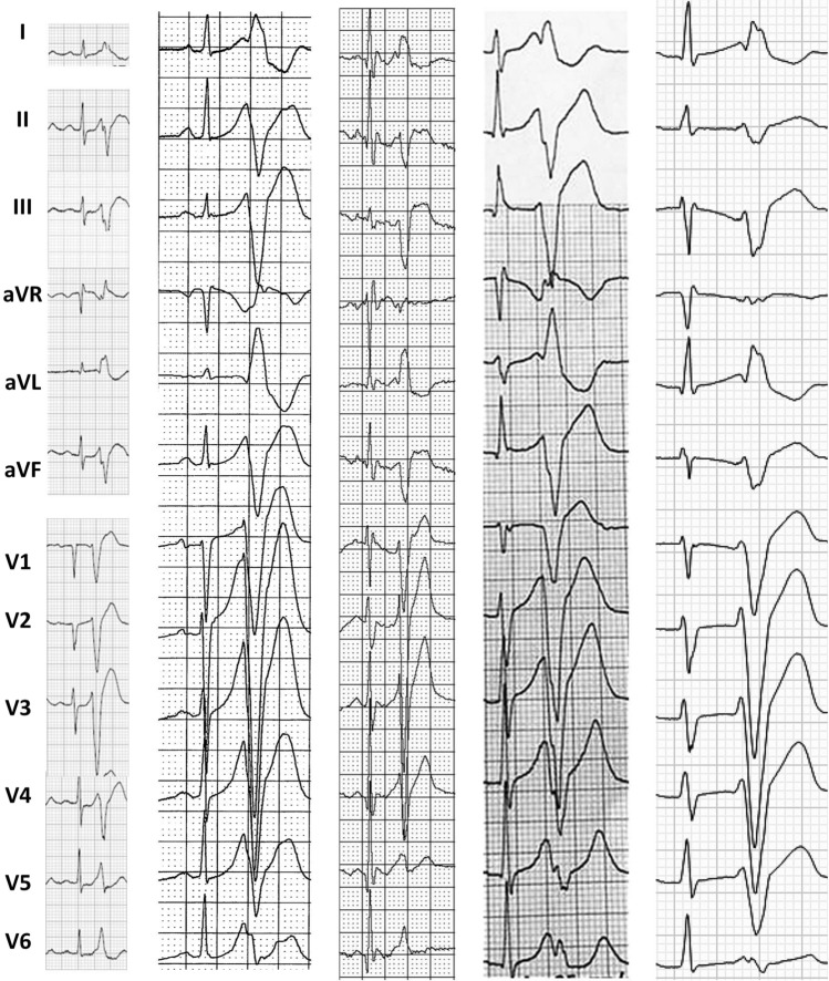 Short-coupled variant of torsade de pointes
