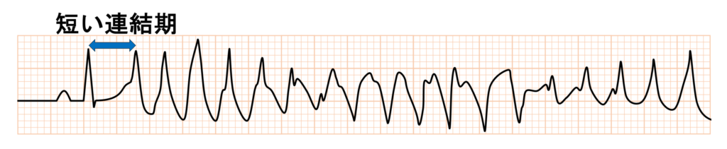Short-coupled variant of torsade de pointes