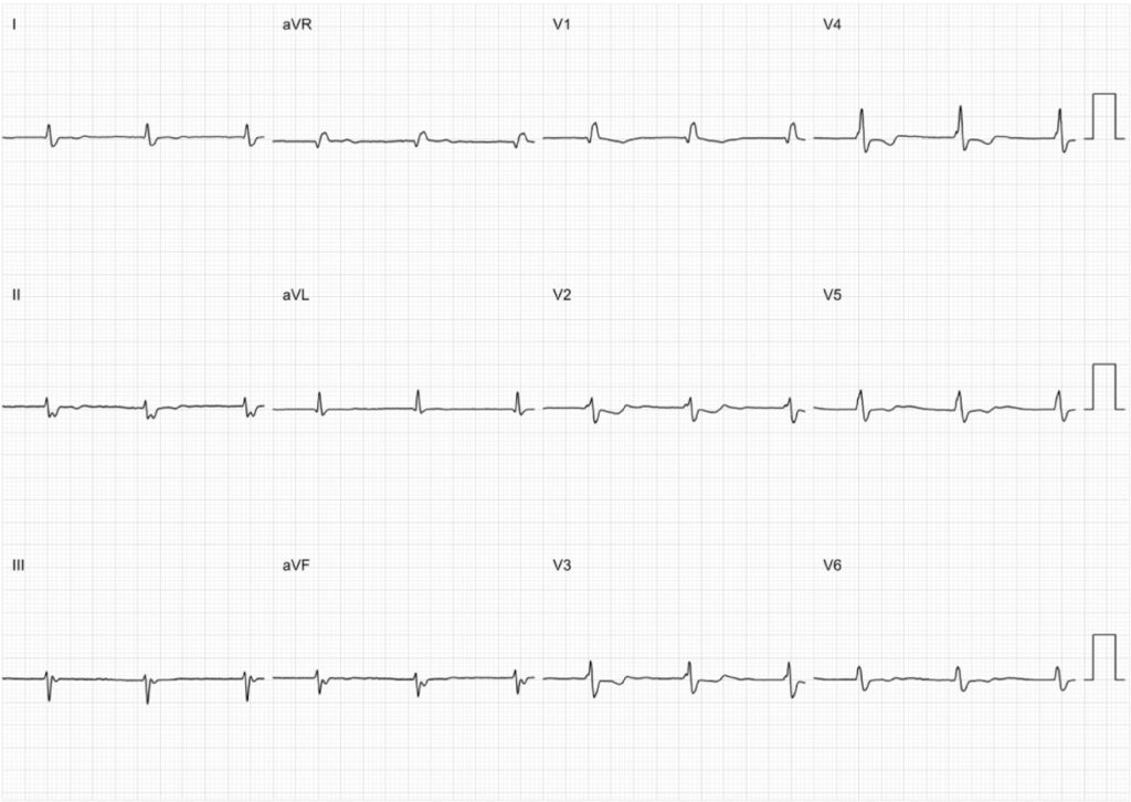 心房静止(atrial standstill)