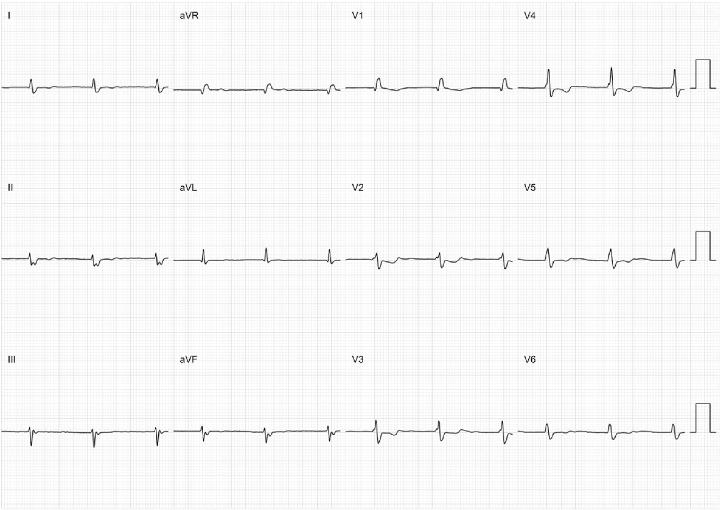 心房静止(atrial standstill)