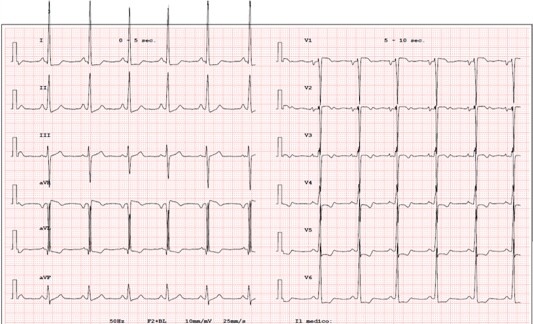 肥大型心筋症(hypertrophic cardiomyopathy)