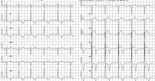 肥大型心筋症(hypertrophic cardiomyopathy)