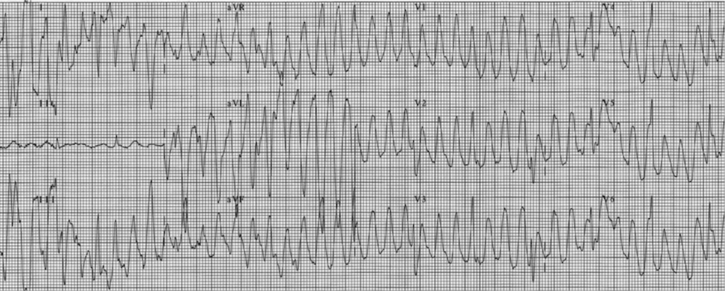 Sinus signとは?
Sinus signとは、主に体動や振戦によるアーチファクトが心室頻拍様に見える場合に、本物の心室頻拍と鑑別するためのサインの一つです。Huangらが提唱した、振戦による偽物の心室頻拍を見分ける3つのサインのひとつであり、他にはSpike sign、Notch signがあります