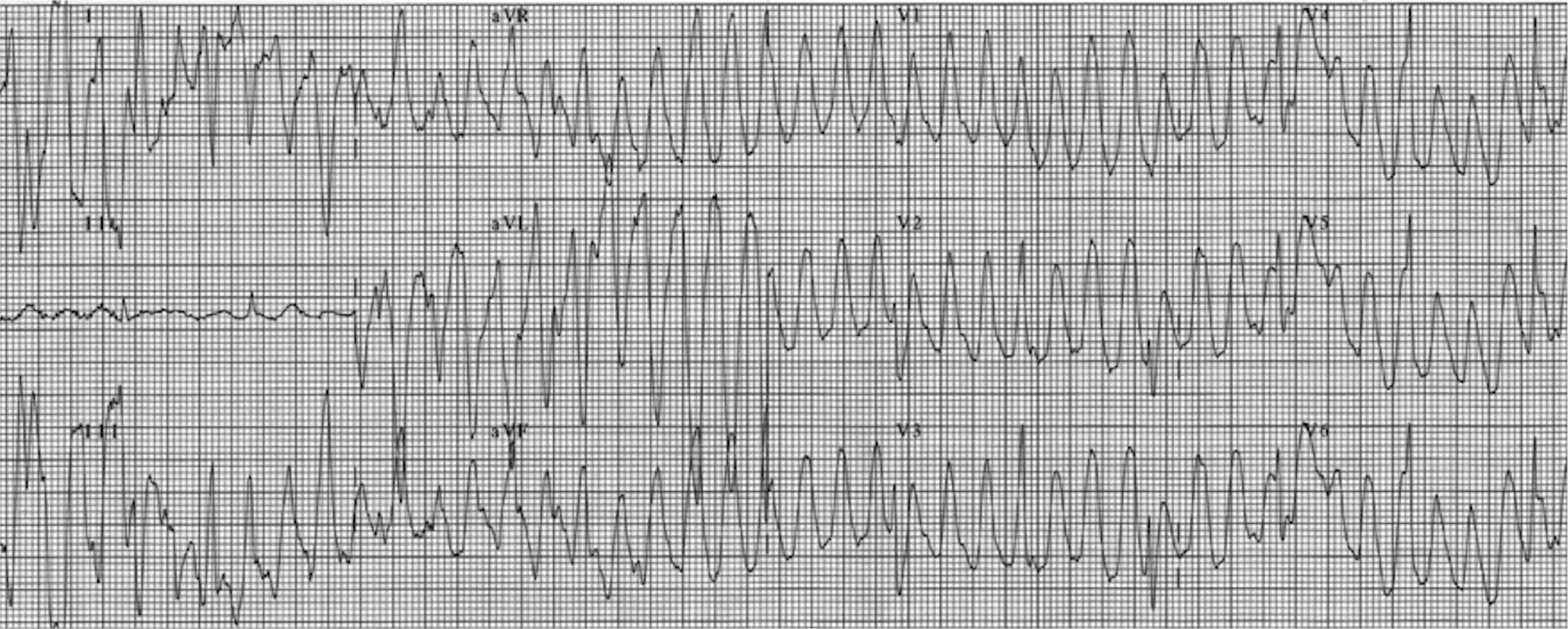 Sinus sign