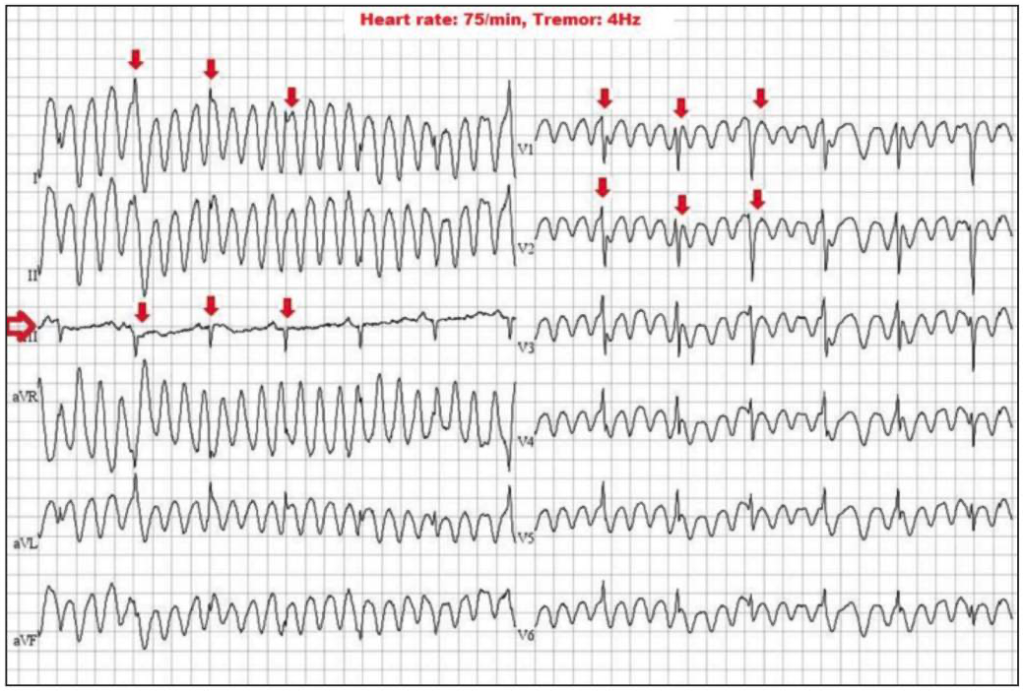 Sinus sign