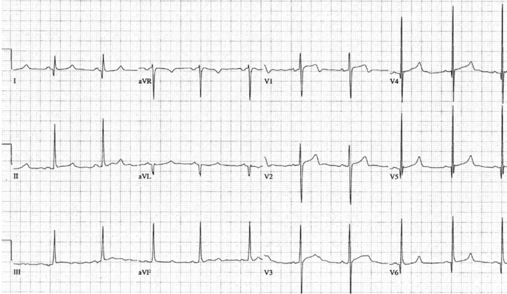 肥大型心筋症(hypertrophic cardiomyopathy)