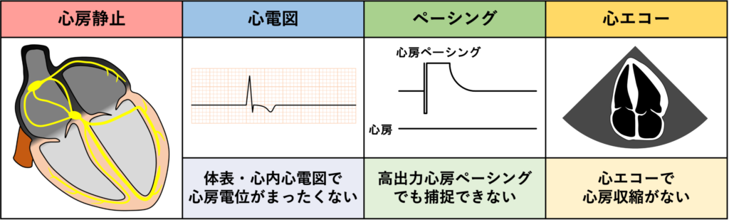 心房静止(atrial standstill)
心房静止とは、心房筋の電気的興奮と機械的収縮がともに消失した状態です。洞結節が単に興奮を出さない洞停止とは異なり、心房心筋そのものが興奮不能になっています。体表心電図・心内心電図でP波・f波・F波など心房興奮を示す波がまったく認められず、高出力の心房刺激にも反応しない場合に診断されます。