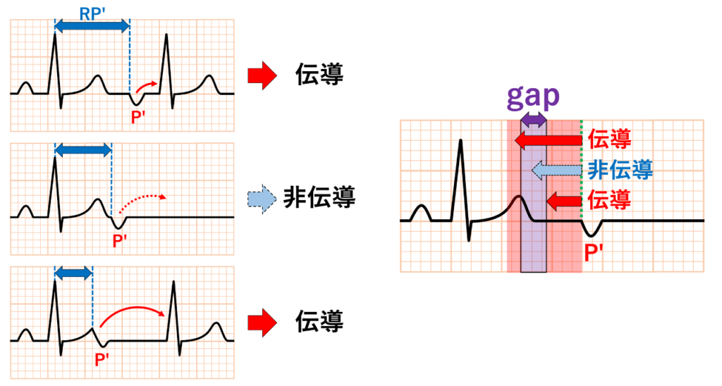 gap現象(gap phenomenon)
gap現象とは、主に刺激伝導系において伝導性が悪くなるはずの早い刺激がむしろ伝導し、少し遅い刺激が伝導しないという現象です。一定の基本調律において心房性期外収縮が発生した場合、連結期が短縮すれば心房の興奮は心室へは伝導されず非伝導性心房性期外収縮となります。ここで、さらに連結期が短縮した場合に房室伝導が回復し心房興奮は再び心室へ伝導されることがあります。このように房室伝導が途絶する一定期間を房室伝導における「gap」と呼んでいます。