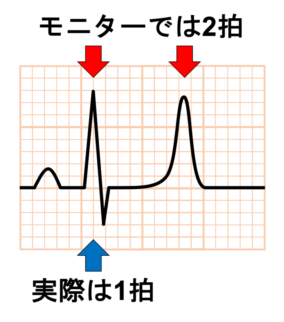 Littmann sign(リットマンサイン)
高カリウム血症では、T波が高く鋭くなる、QRS幅が延長する、QRSとT波が接近あるいは融合するため、自動解析がT波をQRS波と誤認識し、本来1拍のところをQRS波 + T波 = 2拍として数えてしまいます。これがダブルカウントです。