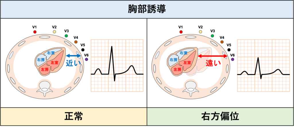 右方偏位(dextroposition)
心臓が右側に偏位しているので左胸部からは離れています。そのため左側胸部誘導(V5-V6)が低電位になりやすいです。