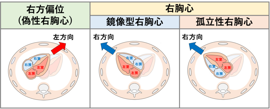 右方偏位(dextroposition)

右方偏位とは、心臓が右胸腔側に偏って位置している状態を指します。 心臓全体が右に移動・偏位しており、心基部から心尖への軸は、左方向を保っています。心腔内の左右関係、心房・心室の位置関係は一般的に正常です。これに対して、右胸心は心臓が右胸腔側に位置していますが心尖が右を向いている状態を指します。そのため右方偏位は右胸心の定義には当てはまらず、偽性右胸心(pseudodextrocardia)ともよばれています1)。