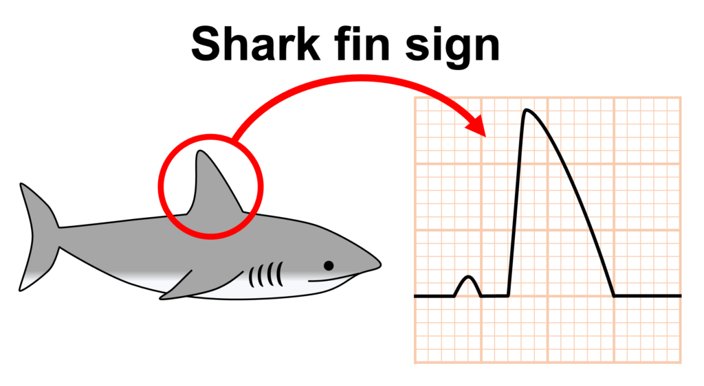 Shark fin signとは?