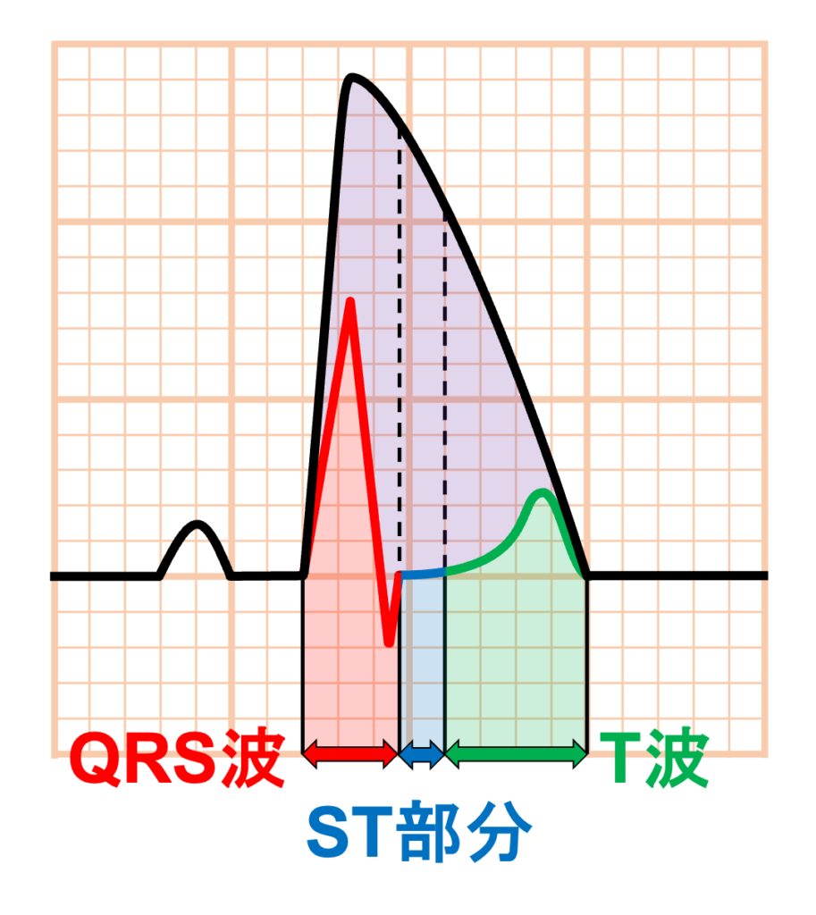 Shark fin signとは?
通常の心電図では、QRS波とST部分とT波は時間的に分離しています。ところが広範囲の重症心筋虚血になると、心室の脱分極・再分極の時間的・空間的な関係が大きく変化します。その結果、QRS波の終末部からST部分、さらにT波までが連続した巨大な電位変化として記録されると考えられています。つまり、単純にST部分が異常に高いというより、QRS-ST-Tという本来別々に存在する波形が一つの巨大な波として融合してしまった状態です。
