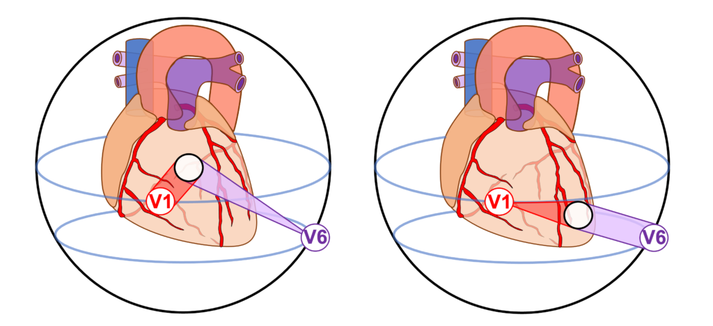 近接効果(proximity effect)

近接効果とは、記録電極と特定の心筋領域の距離が近いほど、その部分の電気活動が体表面電位に強く反映され、振幅が大きくなる現象を指します1)。つまり、ある誘導で記録された波形は心臓全体の電気活動を均等に見ているのではなく、電極に近い部分の活動が相対的に強く見えているということです。これは特にV1〜V6のような胸壁上の電極で重要です。