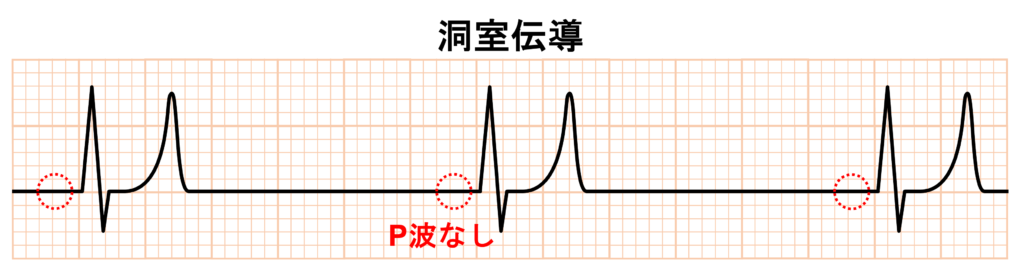 結節間伝導路(internodal tract)
高K血症では通常の心房筋の興奮が抑制されP波が消失しても、結節間伝導路またはそれに相当する抵抗性の高い線維を介して興奮が房室結節〜心室へ伝わることがあり、これが洞室伝導における「P波消失+正常QRS波」の機序の一つとされています。