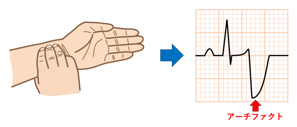 Aslanger’s sign
Aslanger’s signとは、動脈の拍動による心電図アーチファクトを指します1)。arterial pulse–tapping artifactとも呼ばれています2)。同じAslangerの名前がついた心筋梗塞のパターンであるAslanger’s patternとは別物です。