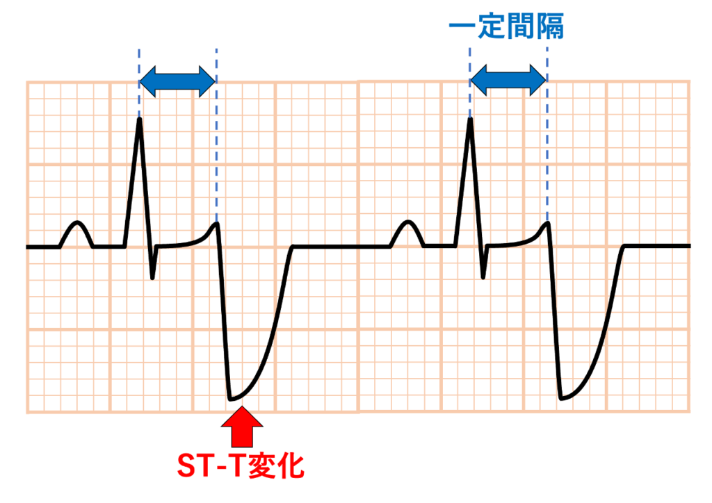 Aslanger’s signとは?
心拍と同期しておりQRS波の後に一定の間隔で出現します。非生理的なST-T変化(急峻な立ち上がり・立ち下がり、広い深いT波様変化など)が生じます。胸部誘導にも波及することがありますが、主に肢誘導で目立ちます。