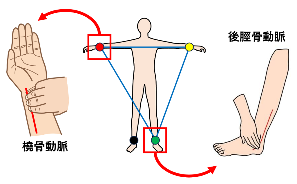 Aslanger’s signとは?
肢誘導の電極(右手・左手・左足)が橈骨動脈や後脛骨動脈の拍動部位の上に置かれたときに起こります。動脈の拍動が電極を機械的に動かして皮膚との接触が心拍ごとに変化することで電位に乱れが生じます。特に高拍出状態(貧血、甲状腺機能亢進、肝硬変、透析シャントなど)で起こりやすいです。