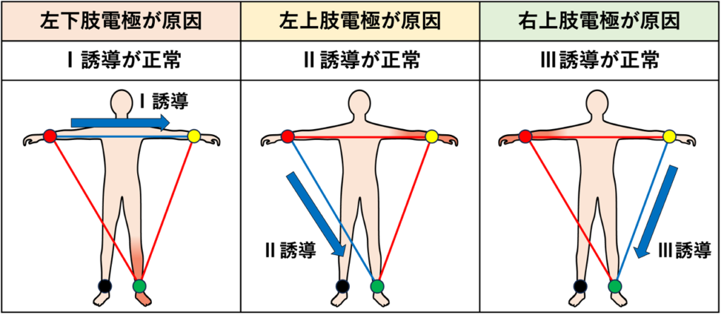 Aslanger’s signとは?
心拍と同期しておりQRS波の後に一定の間隔で出現します。非生理的なST-T変化(急峻な立ち上がり・立ち下がり、広い深いT波様変化など)が生じます。胸部誘導にも波及することがありますが、主に肢誘導で目立ちます。四肢誘導のうち1誘導だけが正常に残るのが最大の特徴です。