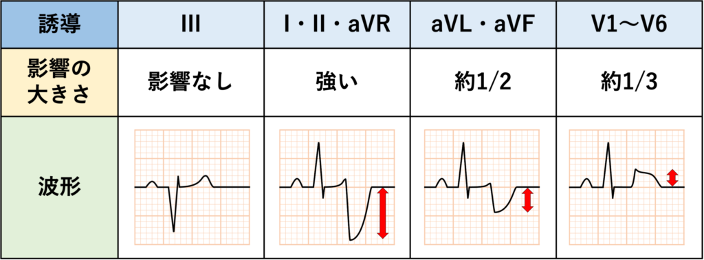 Aslanger’s signとは?
右手の電極にアーチファクトが生じるとWilsonの中心電極にそのアーチファクトが1/3の大きさで混入します。 その結果、胸部誘導には理論上、肢誘導で見られるアーチファクト振幅の約1/3の大きさで影響が現れます。