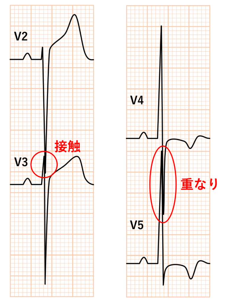Seamens’ Sign胸部誘導(V1〜V6)のうち、隣接する2誘導でQRS波が接触または重なっている場合を陽性とします。数値を測る必要はなく、見た目でQRS波同士が重なっているかを確認するだけのシンプルな基準です。