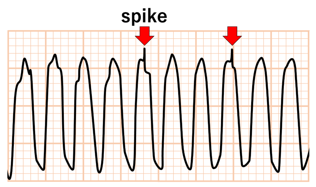 Spike sign
幅の広いQRS波の中に、規則的または不規則な微小スパイクが確認されることがあり、これをSpike signと呼びます。アーチファクトによる偽性の心室頻拍の波形に正常な洞調律のQRS波が重なっていることを表しています。振戦によるアーチファクト波形の振幅が大きいため、本来のnarrow QRS波の一部が小さなスパイクとして見えている状態です。