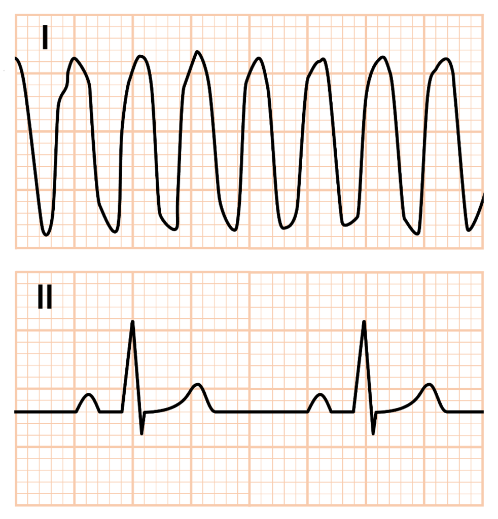 Sinus sign
Sinus signはI・II・III誘導のいずれか1つの誘導でP波・QRS波・T波がはっきりと見える正常な洞調律が保たれていることを指します。