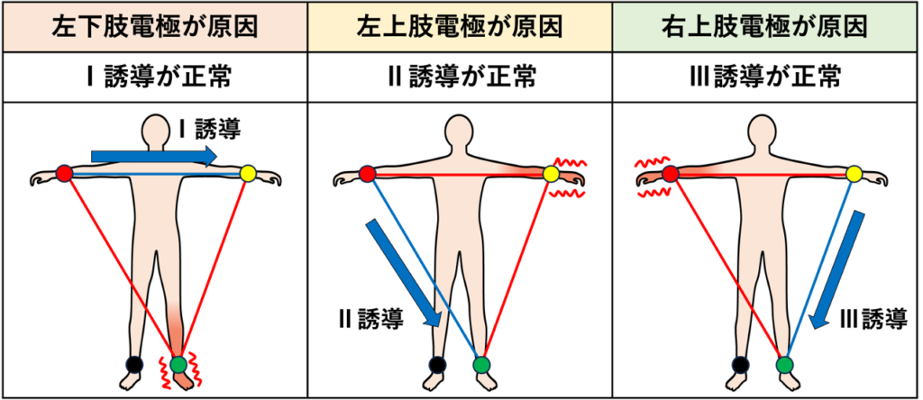 Sinus sign
例えば振戦が右上肢に強く出て、他の四肢にはほとんど出ていない場合、振戦の影響を受けていない電極(左上肢・左下肢)が関与するⅢ誘導では正常な波形が記録されます。 このため1つの誘導だけ正常に見えるという現象が生じます。アーチファクトが肢誘導の1つ以外に生じるメカニズムはAslanger’s signの場合と同様になります。