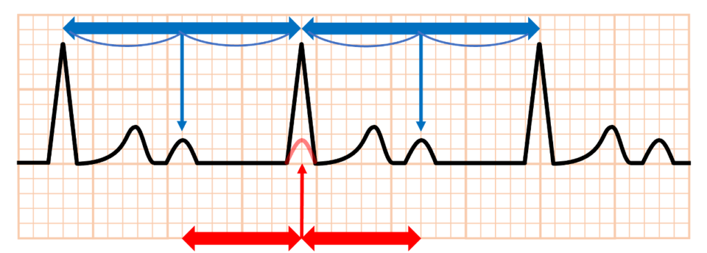 Bix rule
Bix ruleとは2つのQRS波の真ん中にP波が存在する場合、もう1つのP波がQRS波に重なって隠れている可能性があるという法則です。提唱者であるHarold BixにちなんでBix ruleと呼ばれており、隠れたP波を推測するためのルールです。