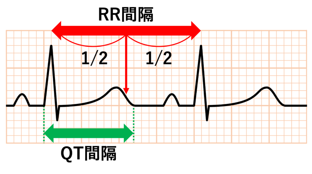 Half RR rule
具体的にはT波の終点がRR間隔の中点を超えていればQT延長と判断します。計算不要で視覚的に判定できるためスクリーニングでよく使われます。