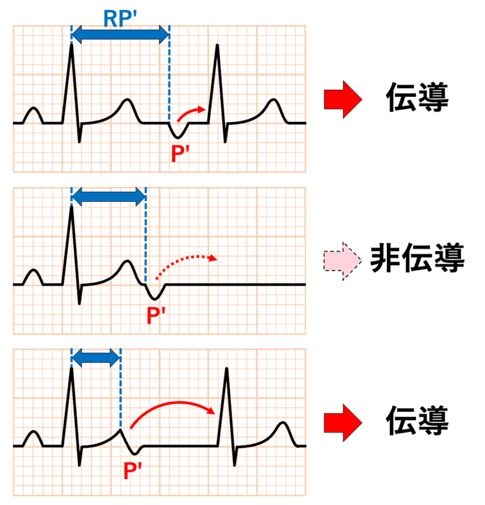 gap現象(gap phenomenon)

gap現象とは、主に刺激伝導系において伝導性が悪くなるはずの早い刺激がむしろ伝導し、少し遅い刺激が伝導しないという現象です。一定の基本調律において心房性期外収縮が発生した場合、連結期が短縮すれば心房の興奮は心室へは伝導されず非伝導性心房性期外収縮となります。ここで、さらに連結期が短縮した場合に房室伝導が回復し心房興奮は再び心室へ伝導されることがあります。このように房室伝導が途絶する一定期間を房室伝導における「gap」と呼んでいます。