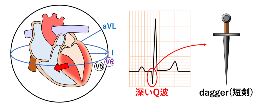 肥大型心筋症(hypertrophic cardiomyopathy)
dagger-like Q wavesとは、肥大型心筋症の中隔肥大で中隔の脱分極ベクトルが異常に増強された結果生じる、幅が狭くて振幅が深いQ波です。daggerは短剣を意味しており、短剣のような鋭い形状のQ波を表しています。側壁誘導からみると中隔の興奮は遠ざかる方向になるため、側壁誘導を中心に下壁誘導にもQ波が出現することがあります。